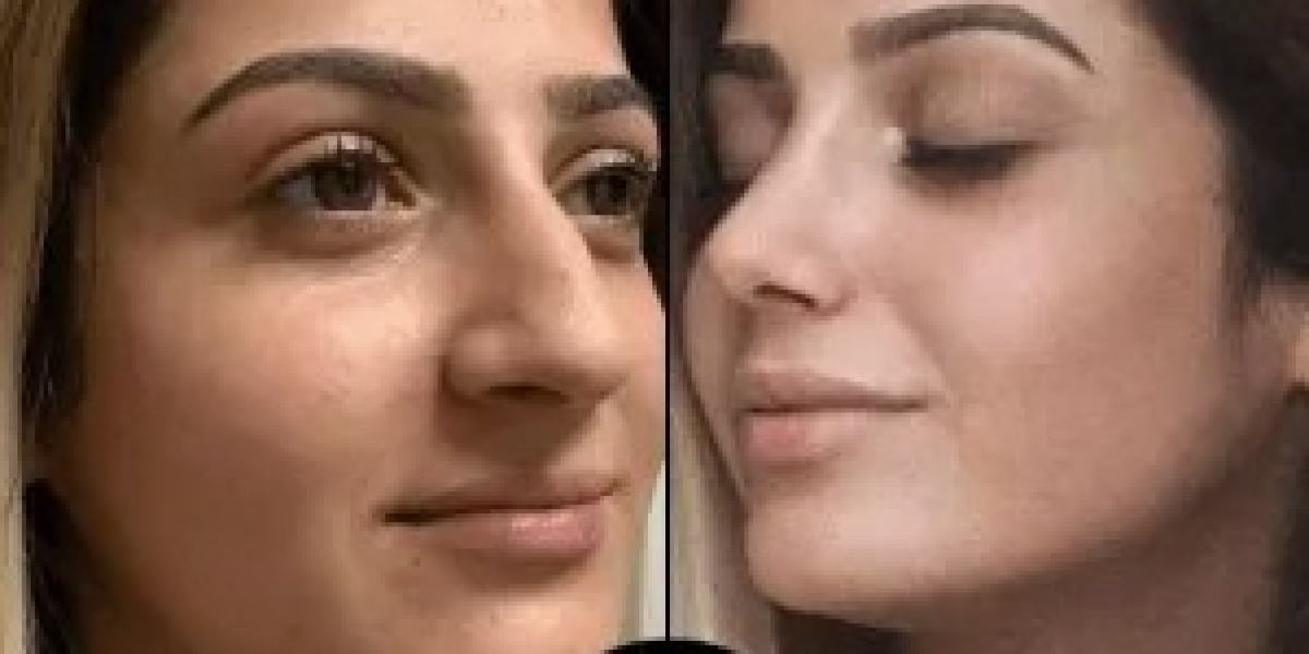 My Journey with PRP Treatments in Dubai – Before & After